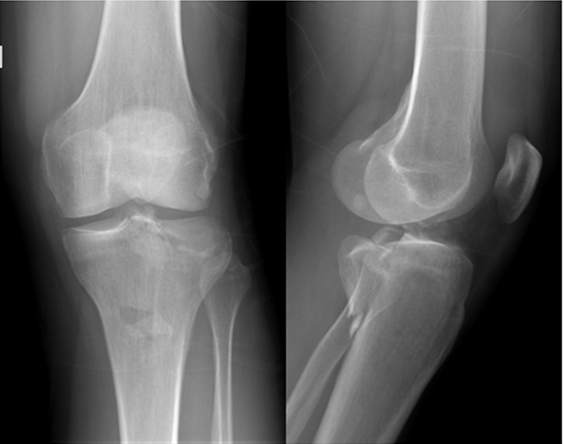 Staple arthroscopic fixation of tibial ACL avulsion with concomitant ...