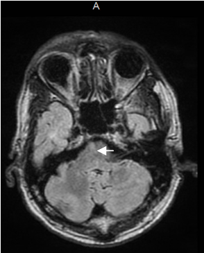 Gender differences in MS related pain correlation with MRI lesion